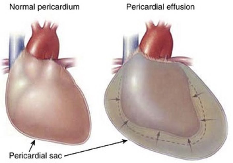Cardiac tamponade ,signs and symptoms, causes ,pathology, diagnosis and treatment
