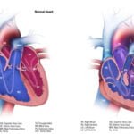 Tetralogy Of Fallot