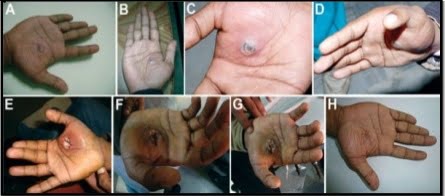 Lesions Of Buffalopox Virus